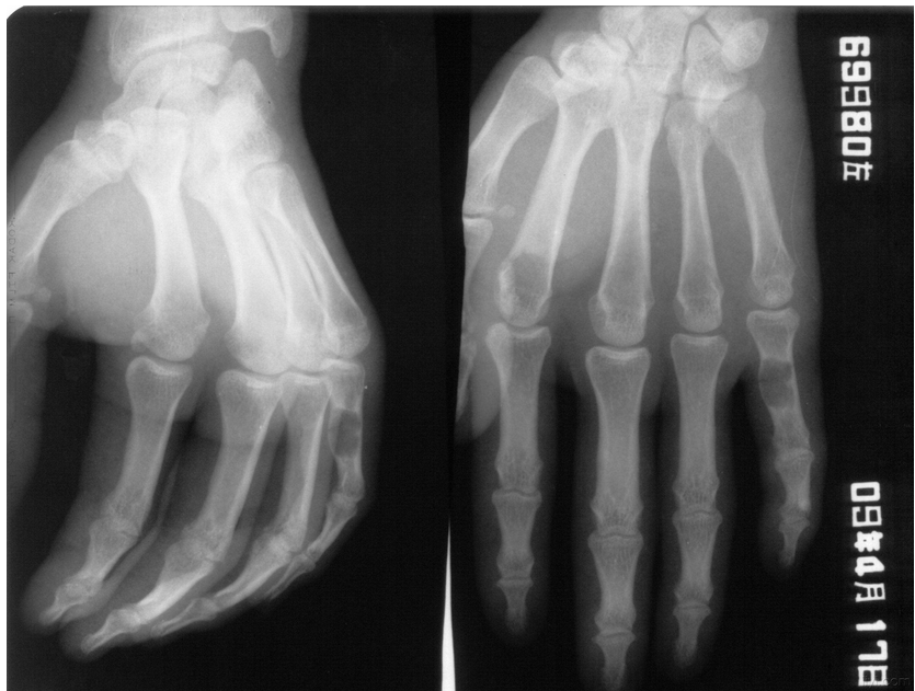 骨外伤患者有哪些康复护理方法？