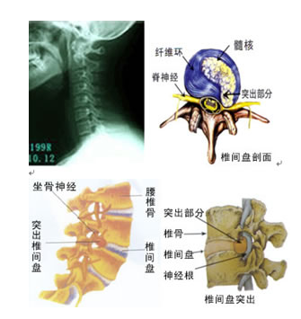 想知道混合型颈椎病是怎样的吗？